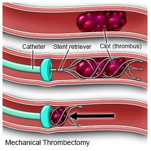 thrombectomy